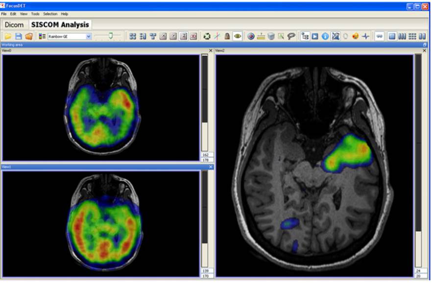 FocusDet user interface showing ictal and inter-ictal SPECTs, their subtraction, all fused with the MRI