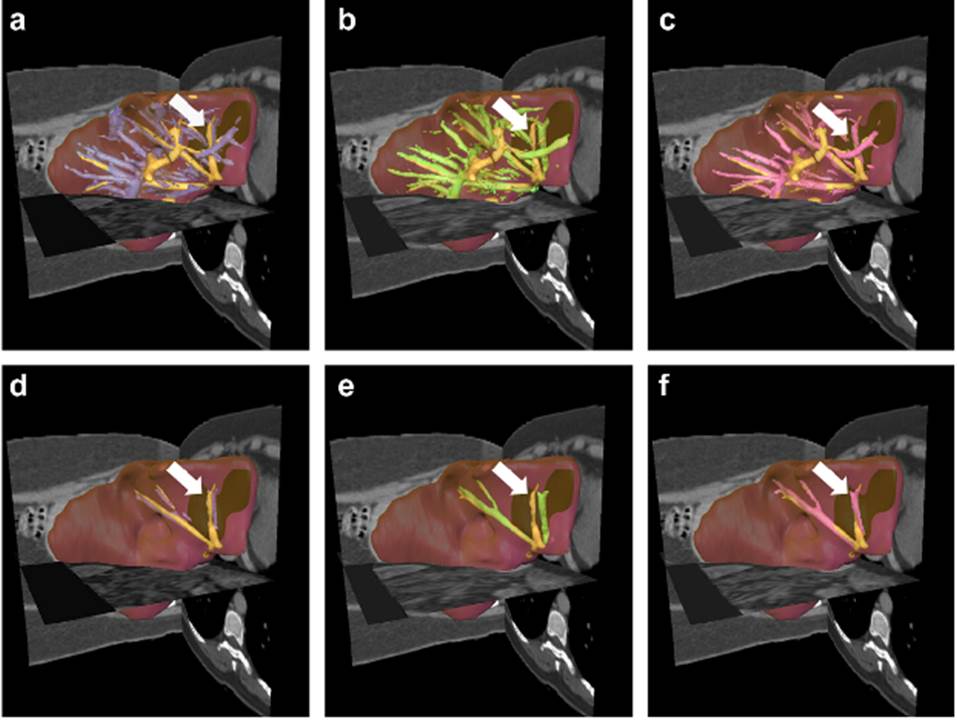 Examples of liver CT and MRI images, before registration, after conventional registration and after proposed organ-focused registration