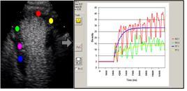 Myocardial perfusion detected with contrast agents